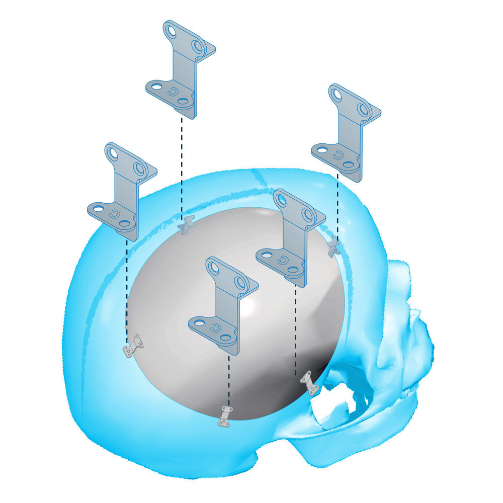 RIALTO system for augmentative craniectomy
