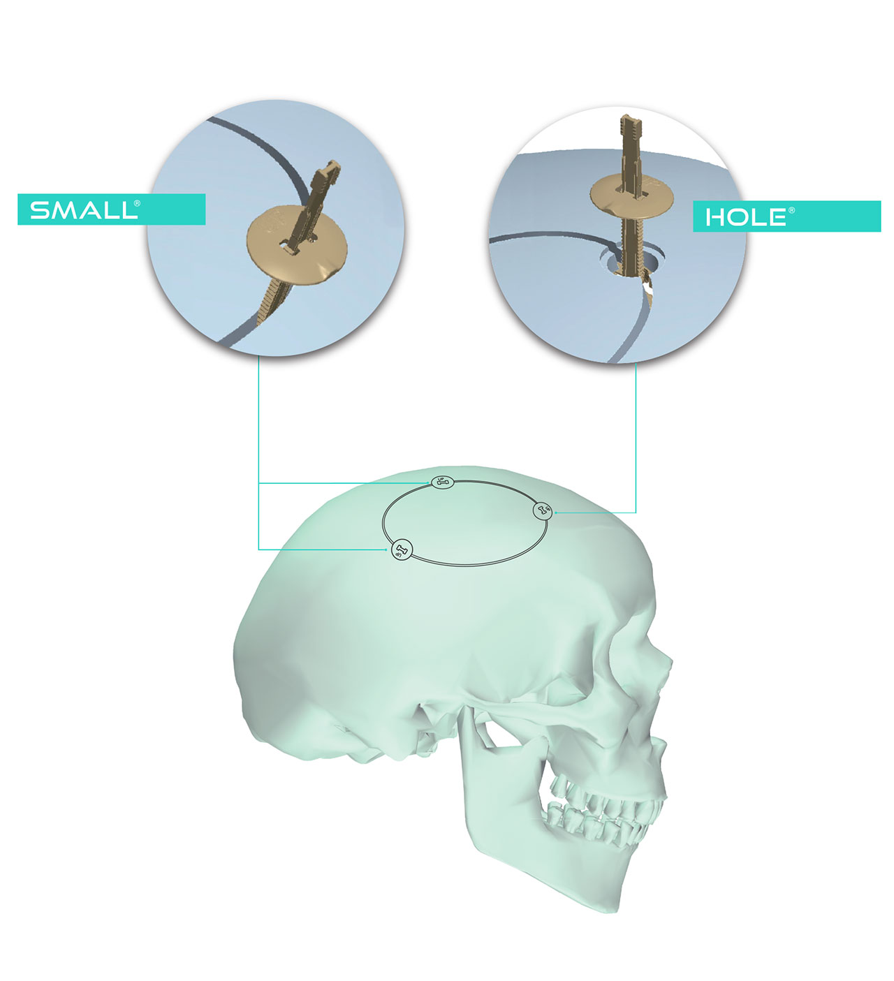 Craniotomy sites for NTCRANIAL devices SMALL and HOLE