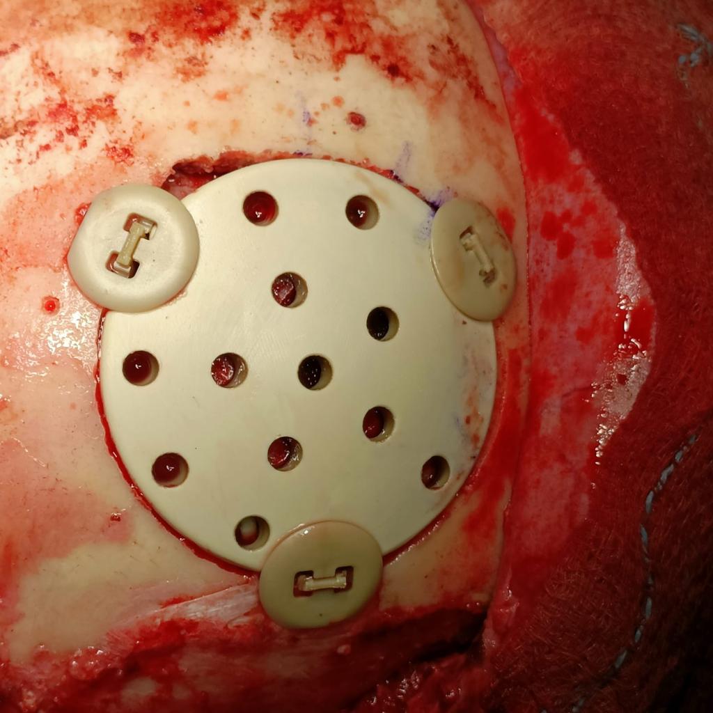 NTCRANIAL clinical application image 01