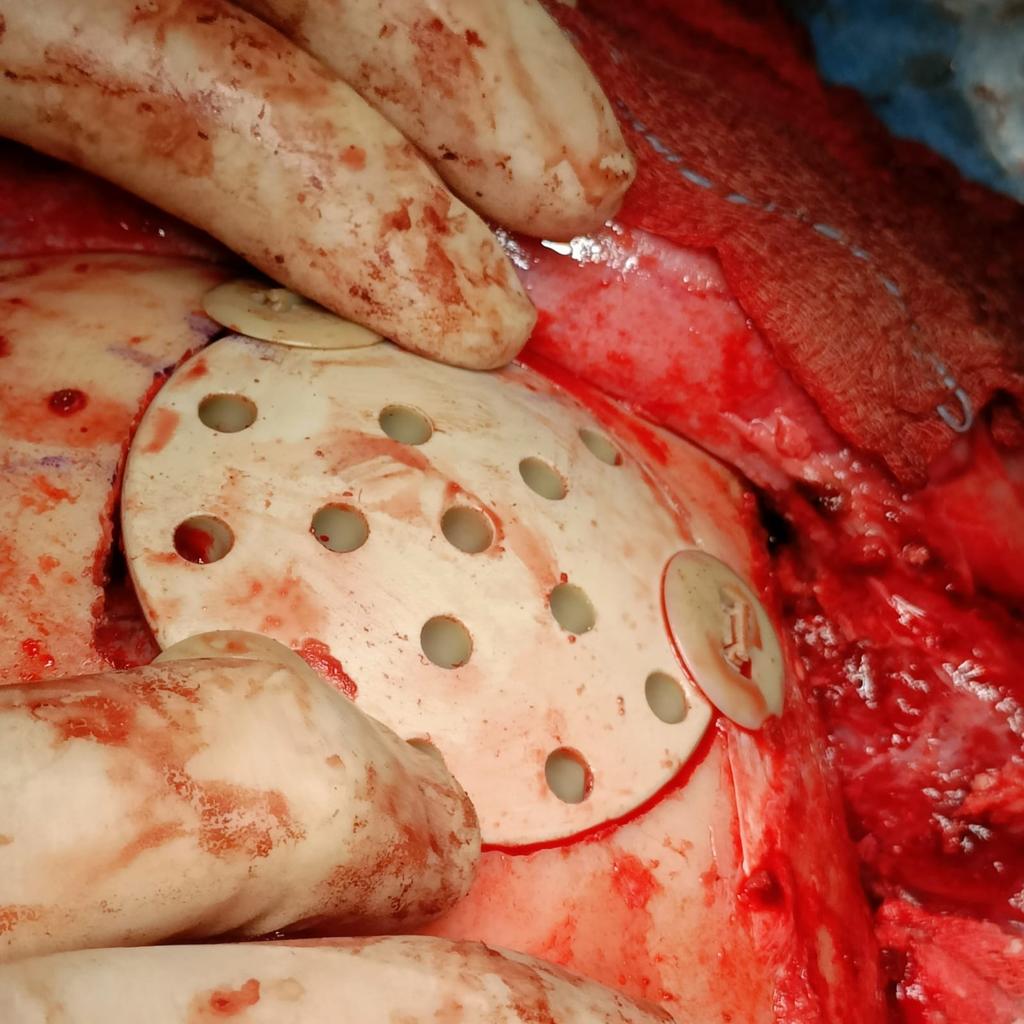 NTCRANIAL clinical application image 02