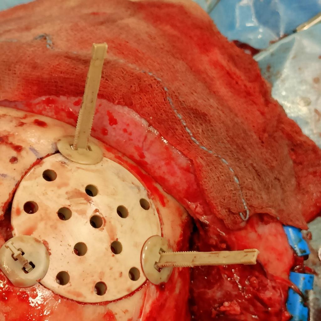 NTCRANIAL clinical application image 03