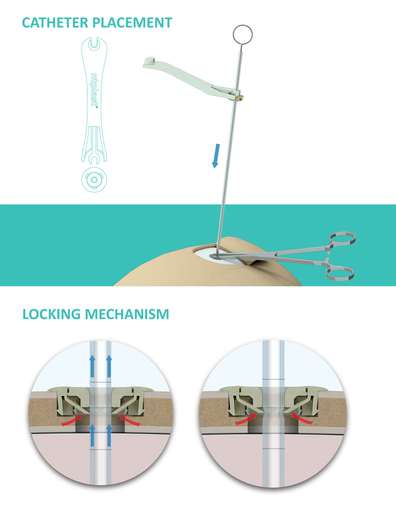 NTDRAIN catheter locking mechanism