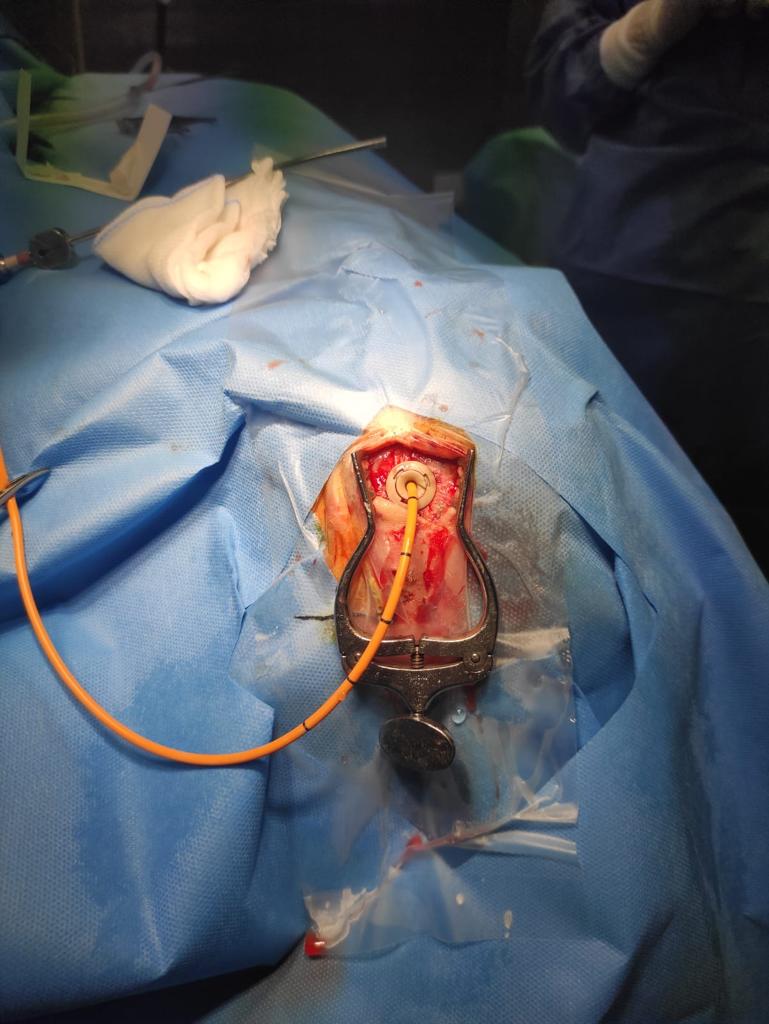 NTDRAIN clinical application image 01