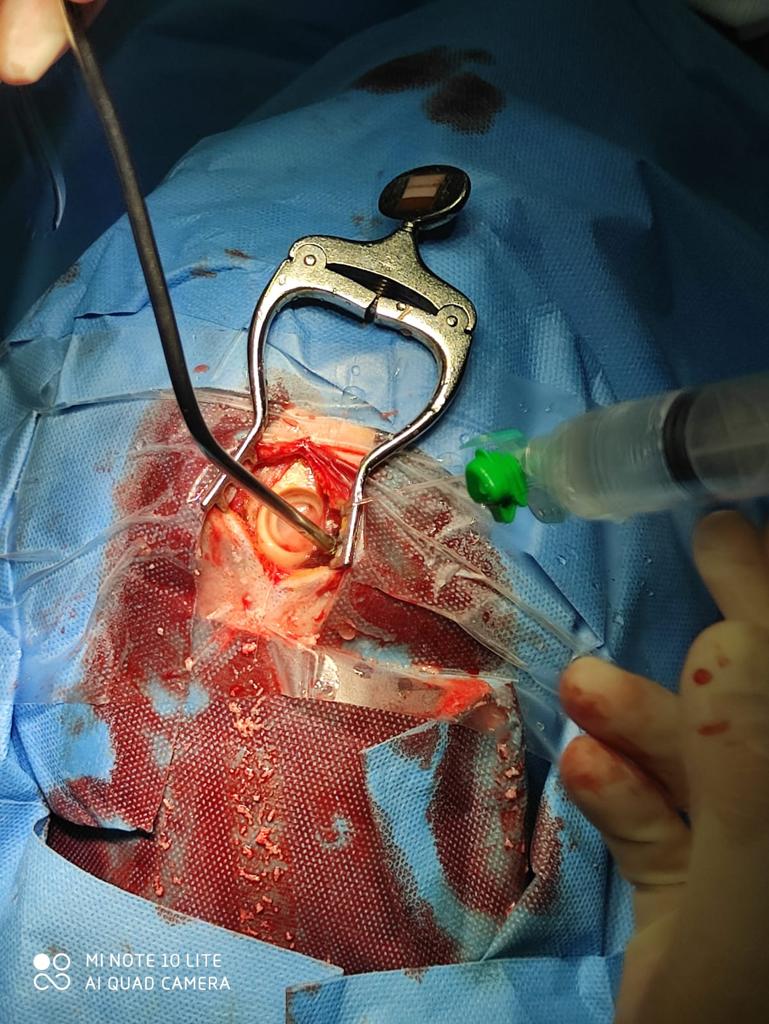 NTDRAIN clinical application image 02
