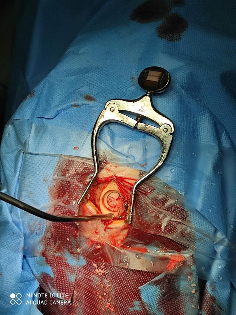 NTDRAIN clinical application image 03
