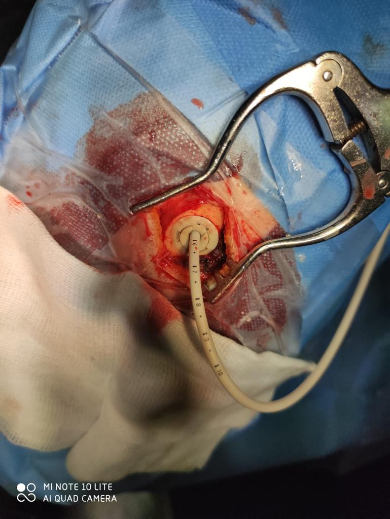 NTDRAIN clinical application image 04